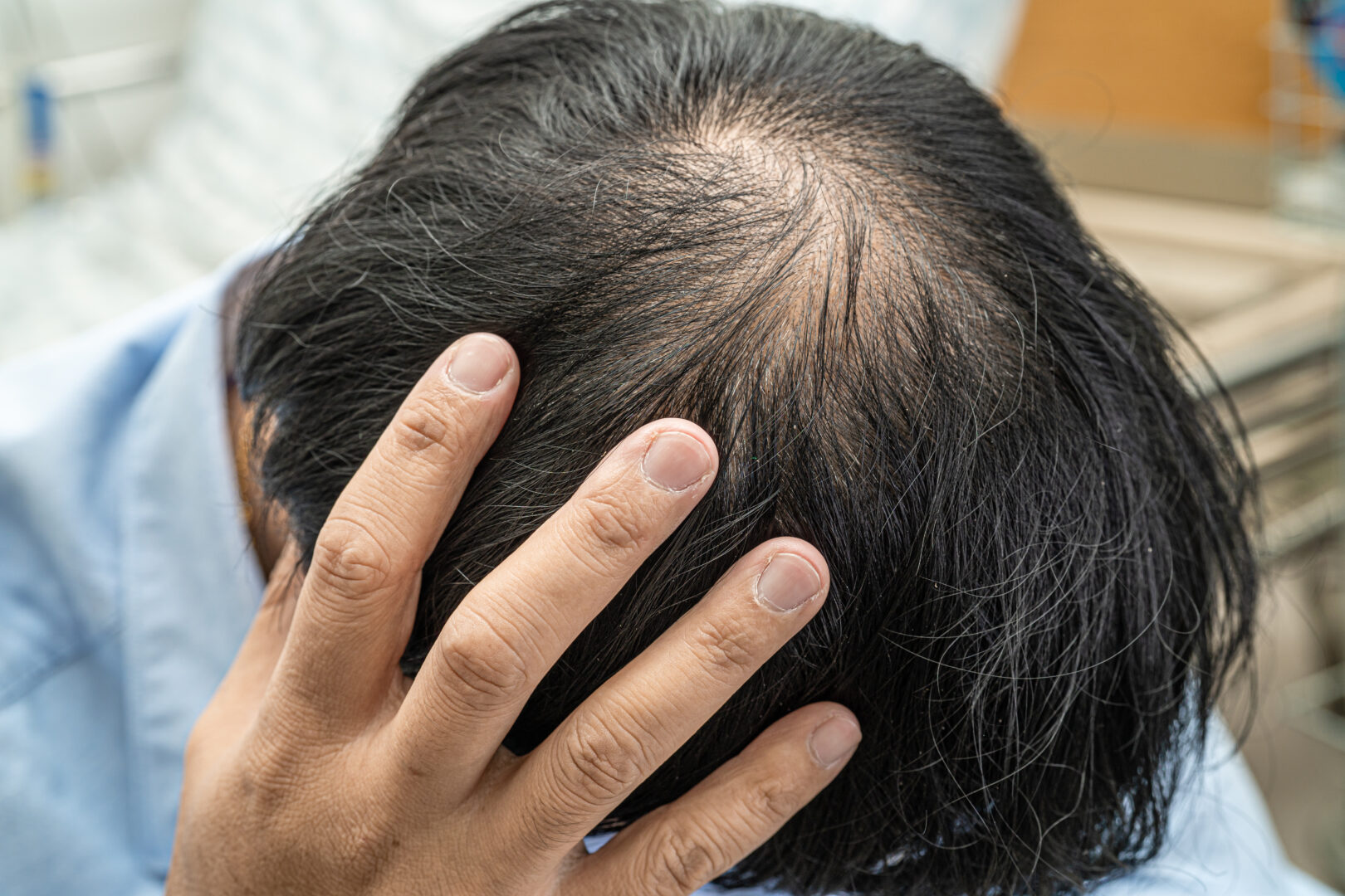 causes et solutions à la perte de cheveux