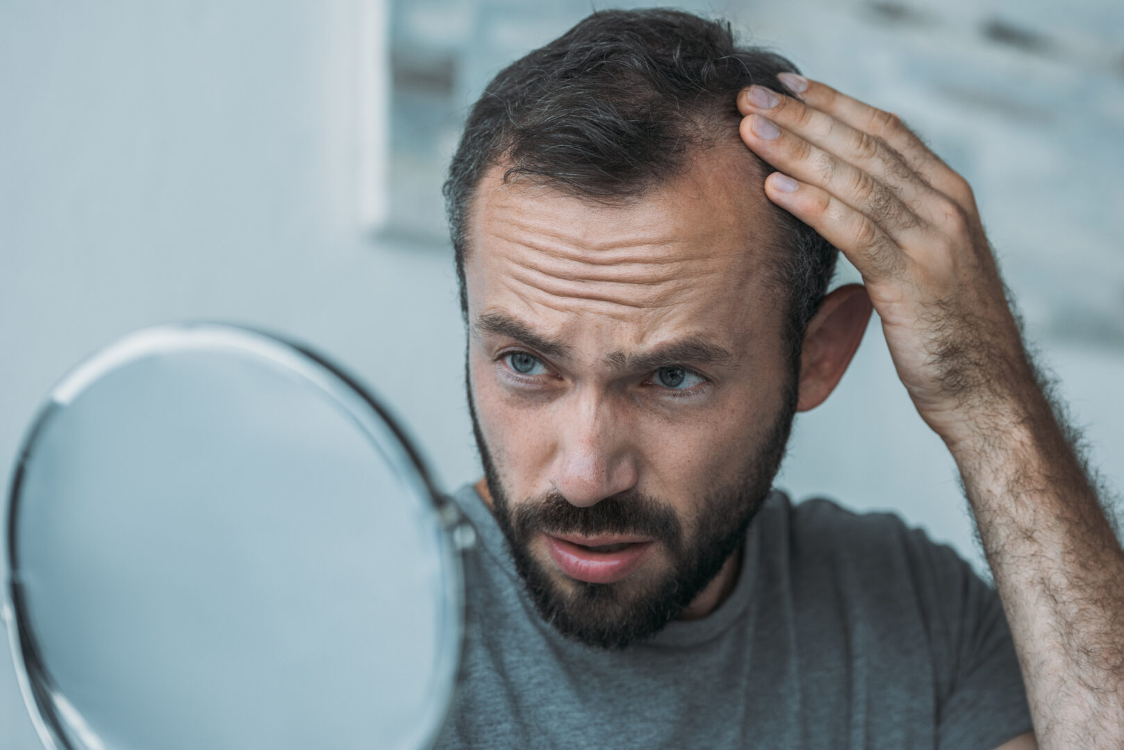 upset middle aged man with alopecia looking at mirror, hair loss concept upset middle aged man with alopecia looking at mirror, hair loss concept